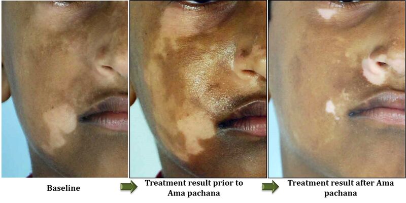 File:Fig 8- Importance of amapachana in vitiligo.jpg