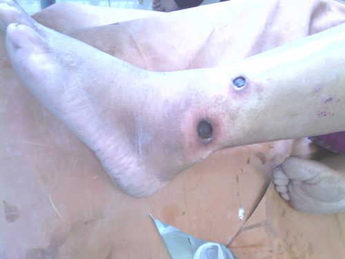 Image 1: Vata dominant ulcer