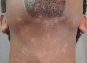 Fig 5- Vata Dominance Vitiligo.jpg