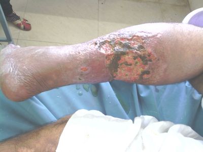 Image 3: Kapha dominant ulcer
