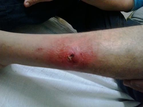 Image 2: Pitta dominant ulcer