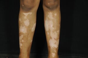 Fig 4- Vitiligo.jpg