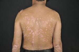 Fig 1- Guttate Psoriasis.jpg