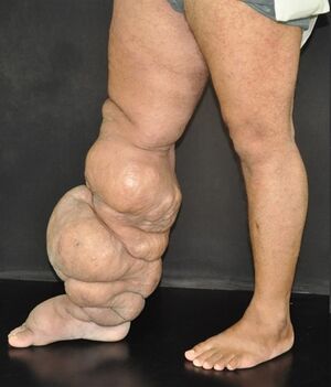 Fig 3-Lymphedema.jpg