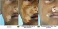 Fig 8- Importance of amapachana in vitiligo.jpg